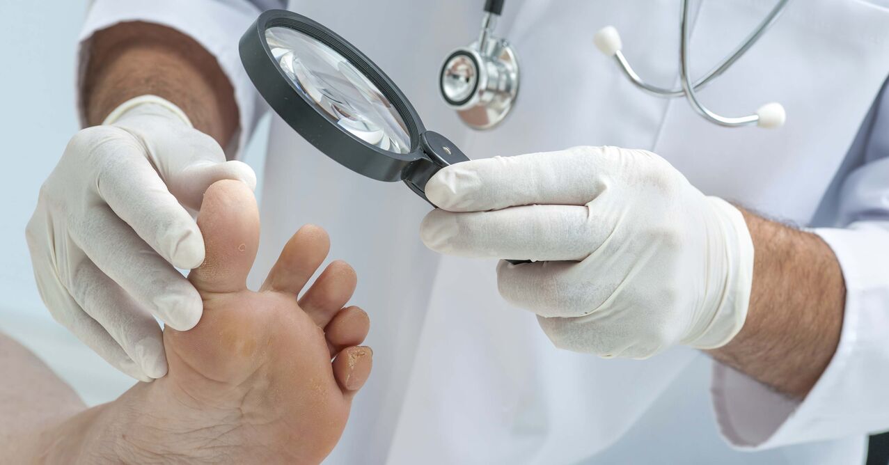 El médico examina los pies en busca de hongos en las uñas