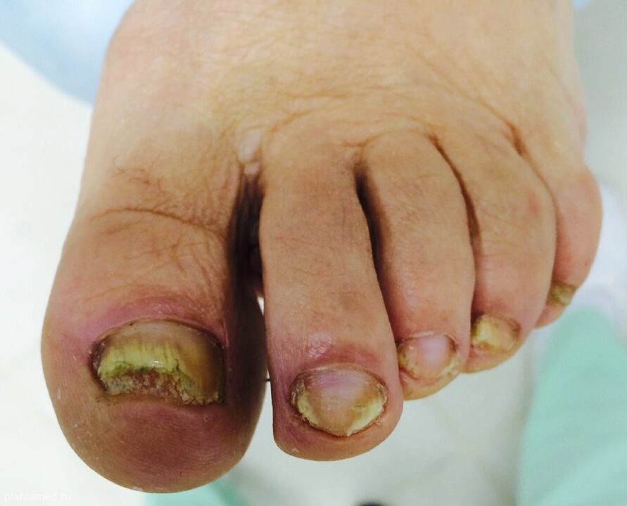 hongos en las uñas de los pies avanzados