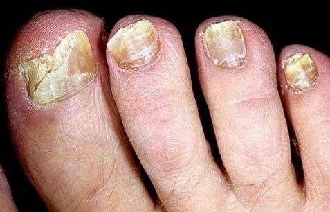 Las uñas se desmoronan del hongo