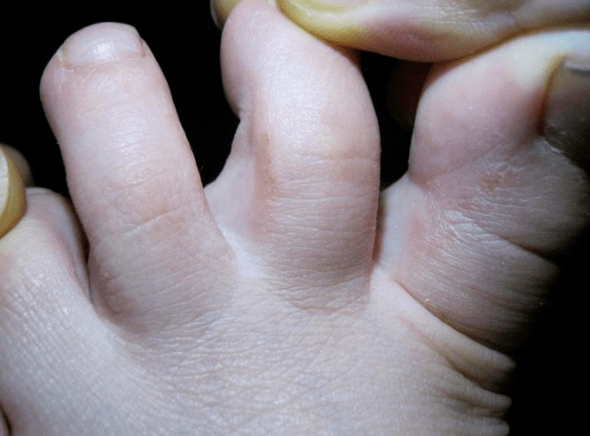 Micosis en niños