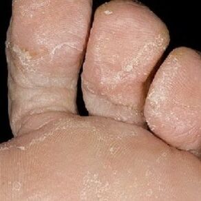 Etapas de los hongos en las uñas