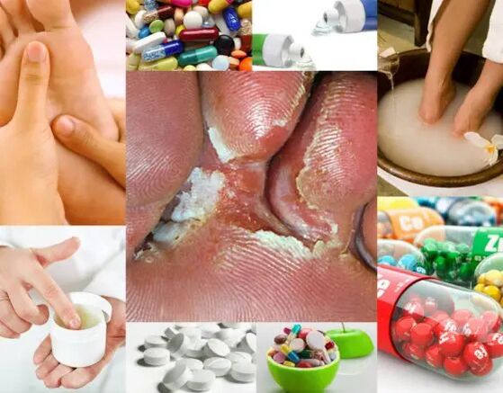 Micosis interdigital y métodos de tratamiento.