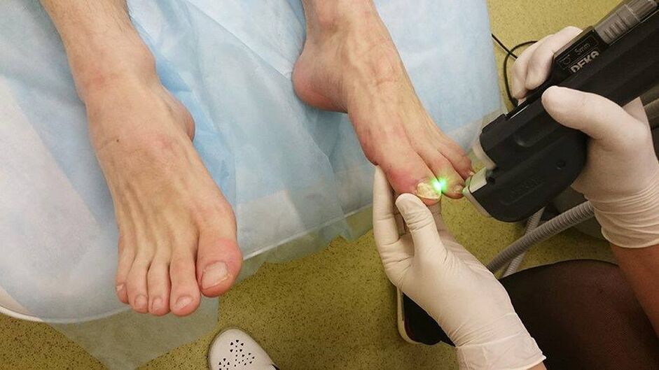 Terapia con láser para hongos en las uñas.