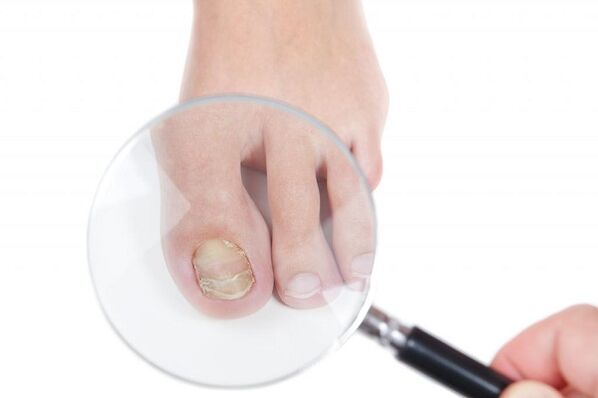 Etapas y etapas de desarrollo de hongos en las uñas de los pies.