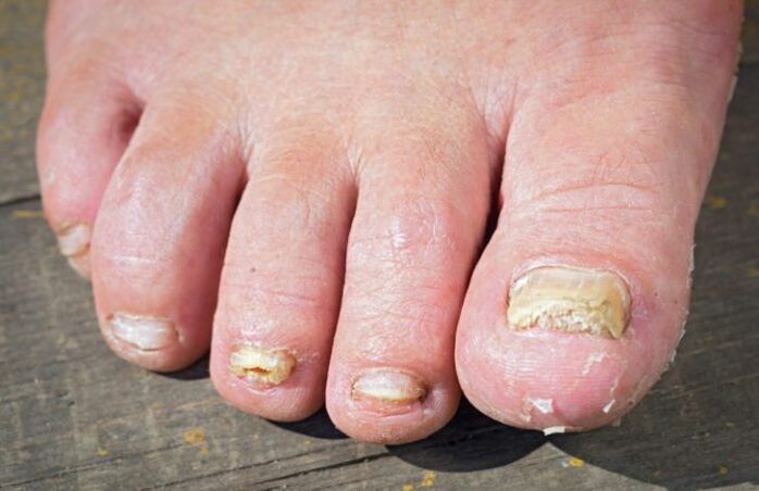 Hongo rubromicosis en los pies.
