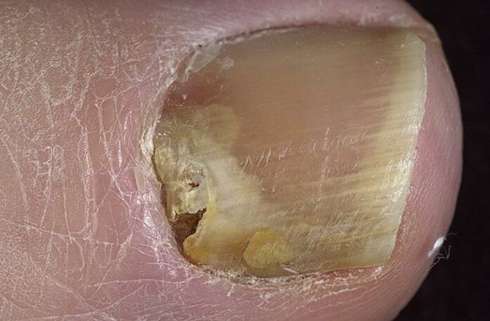 Hongos en las uñas de los pies