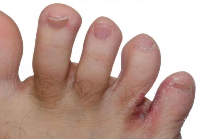 Hongos en los pies entre los dedos.