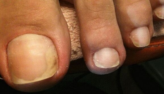 Signos de las primeras etapas de los hongos en las uñas de los pies.